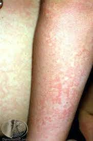 Wann sollte ich zum kinderarzt gehen? Ringelroteln Erythema Infectiosum Deximed