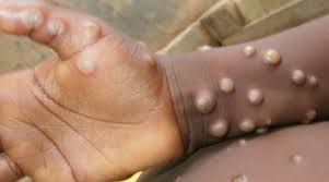 images?q=tbn:ANd9GcSWF-1vkirTHAYVuzZJ35eihPgHO5YIwk2Apw&usqp=CAU Maymun Çiçeği Virüsü pandemiye sebep olabilir mi?