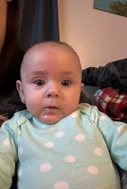 Has anyone talked to a dermatologist about laser therapy for babies birth  mark