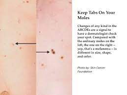 Signs and symptoms of cancer signs and symptoms are ways the body lets you know that you have an injury, illness, or disease. Would You Know Skin Cancer If You Saw It