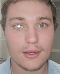 After losing his right eye to illness, Alabama jeweler Slater Jones made a  bold choice: instead of a standard prosthetic, he commissioned a custom  ocular replacement featuring a 2-carat diamond! 👁️💎 More