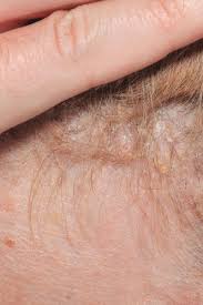 Scalp psoriasis can lead to loss of hair, however it's just temporary. Scalp Psoriasis Symptoms Causes And Treatment