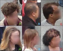 Beside this, how many pubic hairs does the average woman have? Normal Hair Loss Or Too Much Hair Falling Out