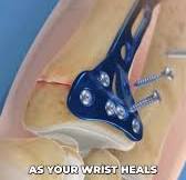 The volar locking plate method is a common surgical technique used to repair distal radius fractures. It involves using a metal plate with locking screws on the palm side of the wrist to stabilize the ...