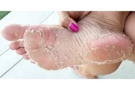 For this reason a cream mask will work best for my feet. Baby Foot Peel Review A Disgustingly Good Time Los Angeles Times