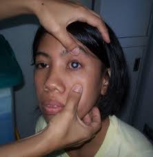 How cataracts affect your vision. How To Detect Eye Cataracts