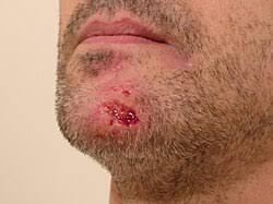 Image result for Neurotic Excoriation