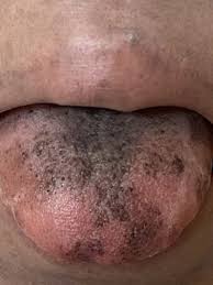 Image result for black hairy tongue symptoms
