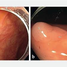 Post-polypectomy scar and residual polyp. Post-polypectomy scar with...