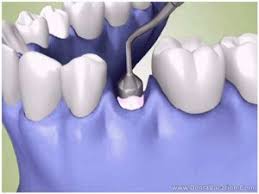 Dental Implants And Bone Grafting Cost And Procedure