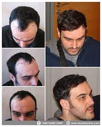Vinci Follicular Unit Extraction Fue Vinci Hair Clinic In 2021 Hair Clinic Hair Grafting Hair Transplant Surgery