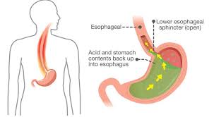 Gastroesophageal reflux disease, also known as gerd, is a common digestive disorder that affects the lower esophageal sphincter (les), the ring of muscle that lies between the esophagus and the. Hidden Facts About Gerd In Esophagitis Naet Dubai