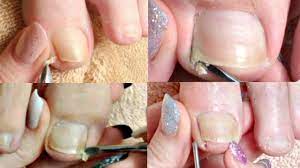 1 Pedicure Big Toenail Cleaning Compilation Real Time Pedicure Tutorial Toe Nails Ingrown Toe Nail