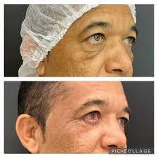 É pouquíssimo tempo entre uma foto e outra: só 10 dias. E mesmo com o  início recente da recuperação, o olhar já transmite mais leveza e descanso.  Esse é um dos efeitos