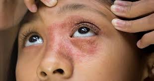 Image result for contact dermatitis