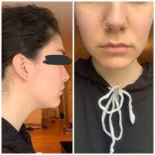 The chubbiness turns into sagging face tissue near one's cheeks, jaw, and chin. I M Sick Of Having No Jawline And Chubby Cheeks Should I Go Right To Buccal Fat Pad Removal Or Try Juvederm Injections I M 21 Plasticsurgery