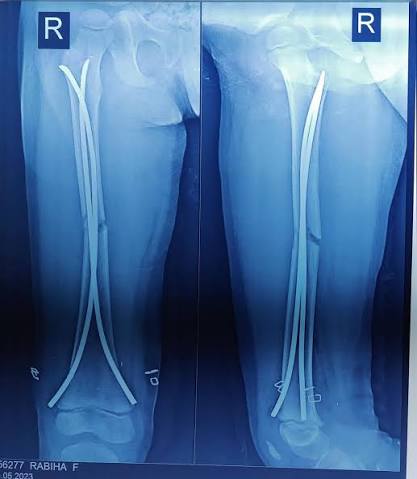 Titanium Elastic Nails (TEN) used for pediatric femur fracture stabilization