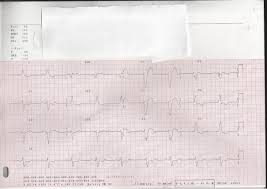 Miocardiopatía hipertrófica, pruebas complementarias, diagnóstico clínico, analítica, electrocardiograma, doppler tisular, resonancia magnética nuclear. Paciente Con Miocardiopatia Dilatada De Origen Isquemico Caso 4 Cardiomap