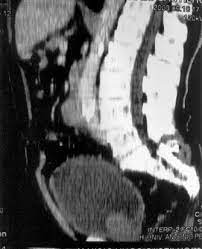 Start studying aneurisma de aorta abdominal. Tc De Abdome Demonstrando Aneurisma De Aorta Abdominal Infra Renal E Download Scientific Diagram