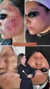 Ana F. Borja| Facials• Acne Fighting • AntiAging| CT (@brivioglowstudio) •  Instagram photos and videos