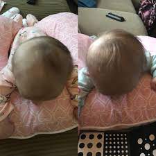 Flat Head August 2018 Babies Forums What To Expect