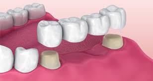 Copper Ridge Dental Crowns Bridges