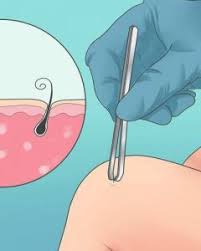 Bacakta Kil Donmesi Ve Kil Batmasi Op Dr Orcun Oral Senturk