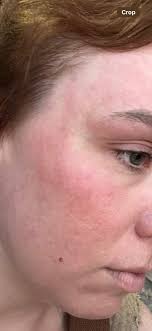 Verapamil as a preventative medication for cluster headaches