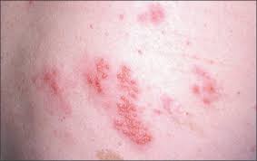 Sign up · learn who is at risk · safety information · vaccine locator Herpes Zoster And Postherpetic Neuralgia Prevention And Management American Family Physician
