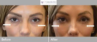 We did not find results for: Before And After Lower Blepharoplasty Photo Gallery Taban Md