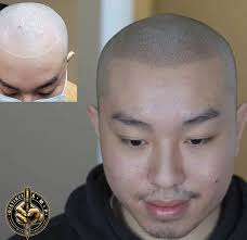 The Non-Invasive and Cost-Effective Hair Loss Solution