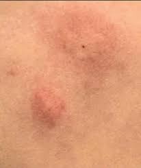 Image result for flea bites
