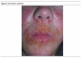 Image result for dermatitis contacta toxica