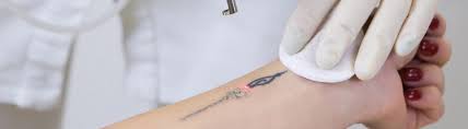 When due to skin conditions. Laser Tattoo Removal Dermal Clinic Beauty Treatments In Edinburgh