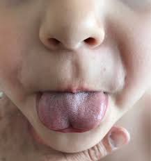 Image result for Ankyloglossia