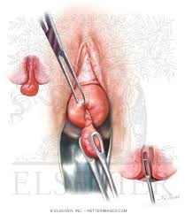 Image result for Uterine Inversion