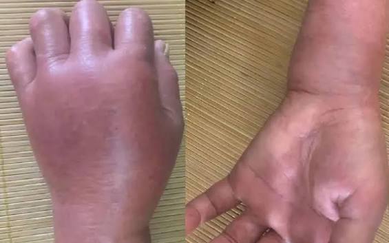Cảnh báo: Ong đốt có thể nguy hiểm tính mạng