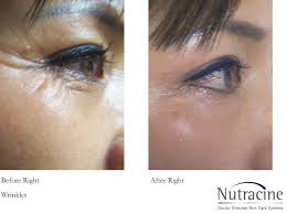 Tretinoin Before And After Wrinkles Www Imgkid Com The Tretinoin Eye Wrinkle Tretinoin Before And After