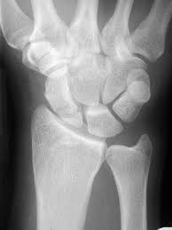 Scaphoid Fracture Msk Medbullets Step 1 The styloid process of the radius. scaphoid fracture msk medbullets step 1