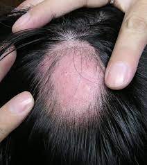 With medical big data and ai algorithms, ehealthme enables everyone to run phase iv clinical trial to detect adverse drug outcomes and monitor effectiveness. Alopecia In Association With Malignancy A Review Springerlink