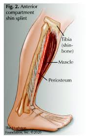 Image result for Tibia Stress Fracture