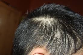 Diese mittellange frisur für männer zeichnet sich durch einen flachen, verjüngten fade mit langem, strukturiertem haar aus, die. Haarausfall Mit 17 Ist Das Besorgniserregend Fotos Haare