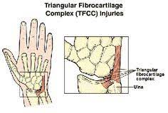 Golf players and tennis players who suffer from a stable tfcc tear are able to start light activity ball contact at 3 weeks after the arthroscopy. Triangular Fibro Cartilage Tear Bangalore Wrist Pain Treatment India