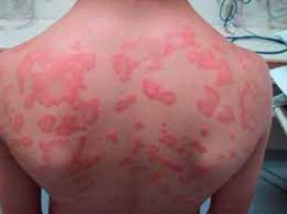 Signs Symptoms Allergy Anaphylaxis Australia