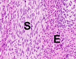 The cytologic features of mesothelioma and other examination . Pathology Outlines Diffuse Malignant Mesothelioma