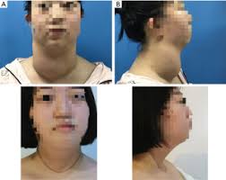 Surgical treatment of children Graves' disease with huge goiter—a case  report and literature review