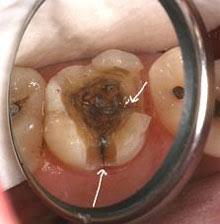 Image result for Pulpitis