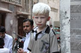 In tanzania, people born with albinism are believed to be 'ghosts' who bring bad luck to their families. The Harmful Invisibility Of People With Albinism Samuel Centre For Social Connectedness Samuel Centre For Social Connectedness