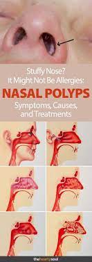 With Allergy Season Coming Up It S Pretty Common To Suffer From A Stuffy Or Runny Nose Every Once And A While That Be Sinus Infection Symptoms Allergies Polyp