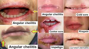 Image result for Angular Stomatitis
